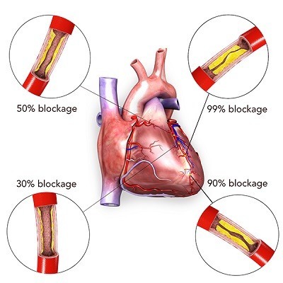 Metabolicsyndrome