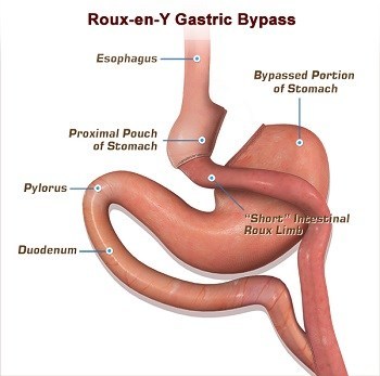 Gastric Bypass