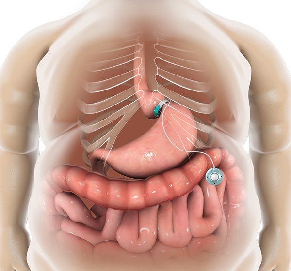 laproscopic gastric binding