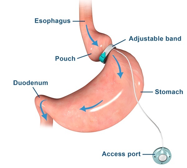 Least traumatic procedure