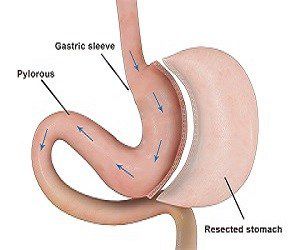 sleeve gastrectomy