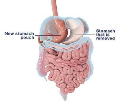 sleeve gastrectomy