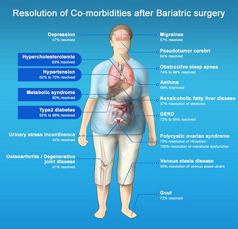 Bariatric surgery